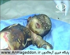 «بدن سوخته» کودک شیرخوار فلسطینی + عکس(18+)